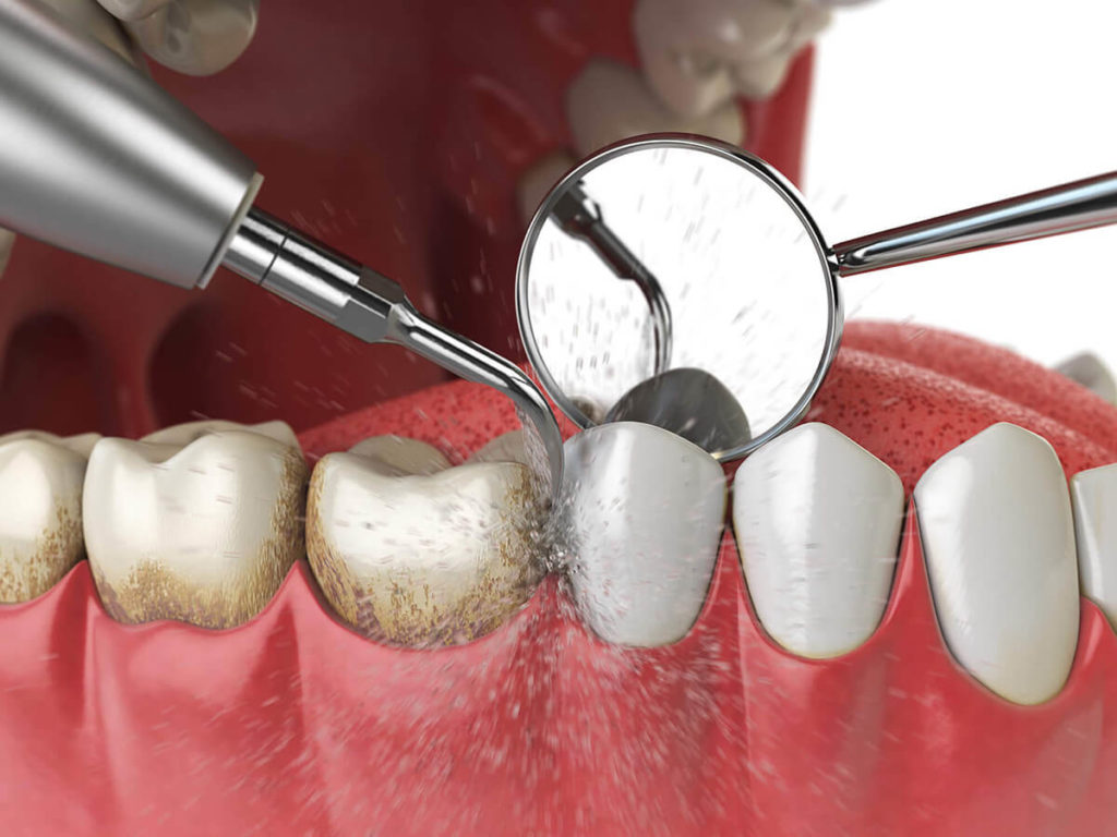 illustration of dental tool cleaning plaque off teeth