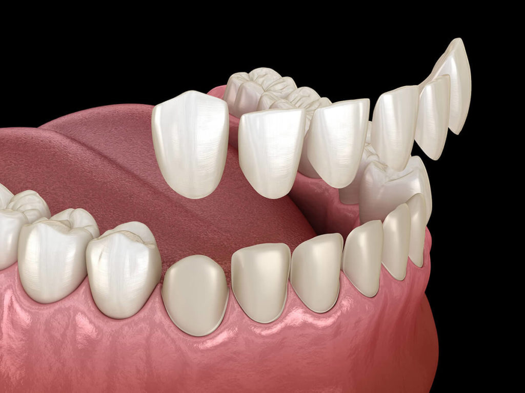 illustration of veneers being placed on teeth