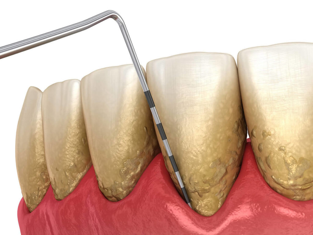 illustration of teeth with gum disease