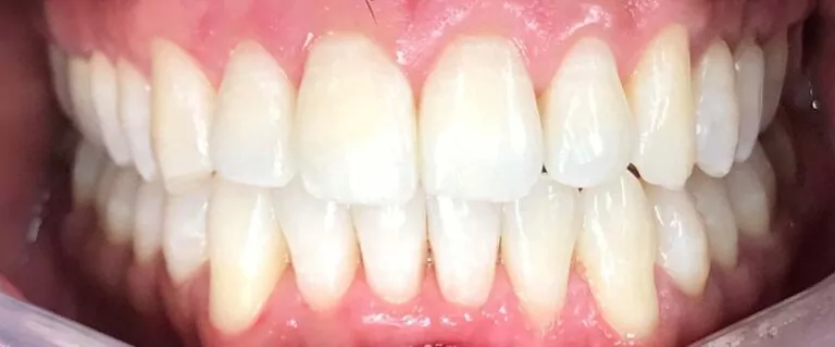The image shows a close-up view of a person's teeth, which appear well-aligned and clean. The teeth are straight, with no visible crowding or gaps, suggesting the results of Invisalign treatment.