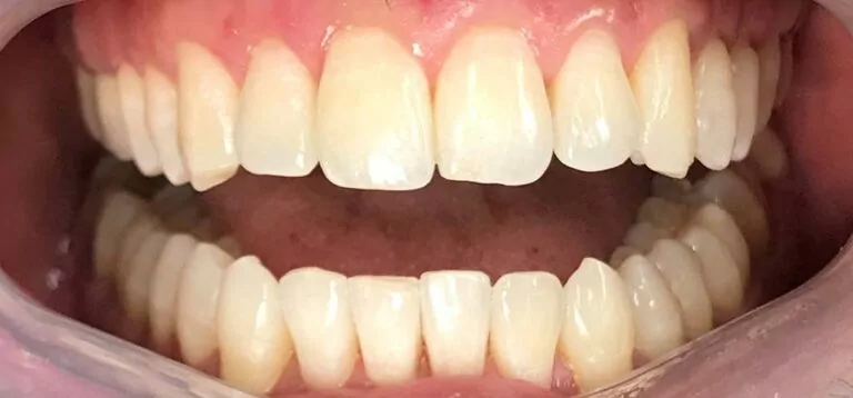 The image shows a close-up view of a person's teeth, which appear well-aligned and clean. The teeth are straight, with no visible crowding or gaps, suggesting the results of Invisalign treatment.