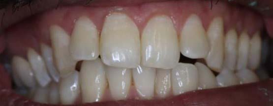 photo of teeth before invisalign