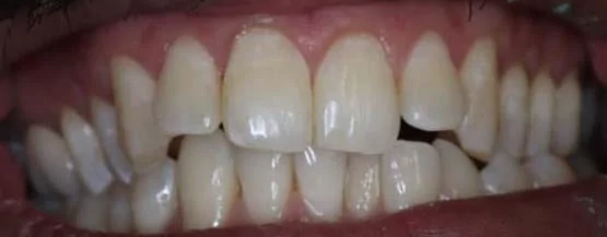 The image shows a close-up view of a person's teeth before Invisalign treatment. The teeth appear slightly misaligned, with some crowding and uneven spacing.