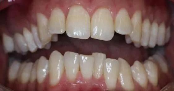 The image shows a close-up view of a person's teeth before Invisalign treatment. The teeth appear misaligned, with noticeable gaps and uneven spacing between the upper and lower teeth.