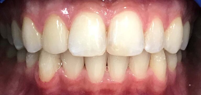 photo of teeth after invisalign