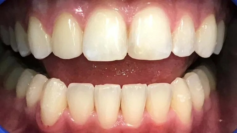 The image shows a close-up of a person's teeth and gums after Invisalign treatment. The teeth appear straighter and more evenly aligned compared to their previous condition.