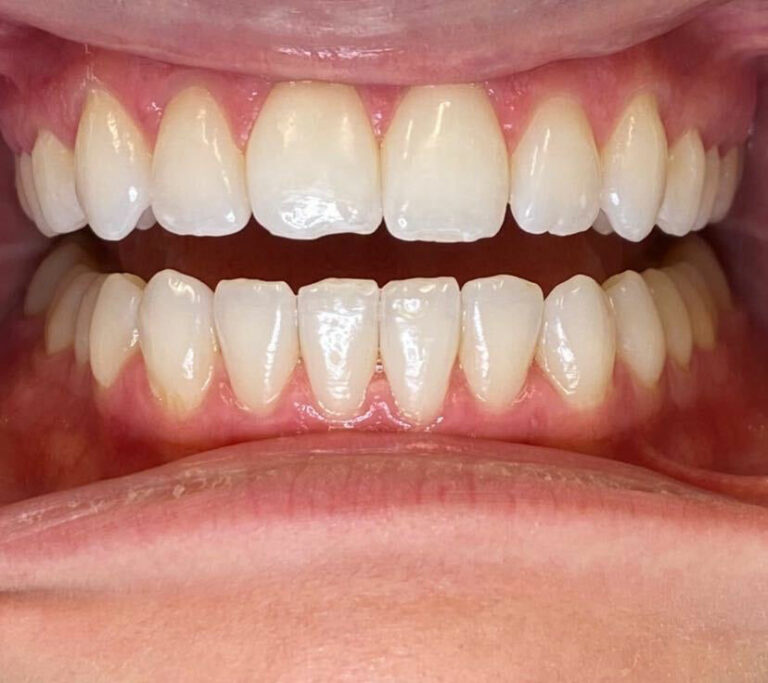 invisalign after smile gallery 3