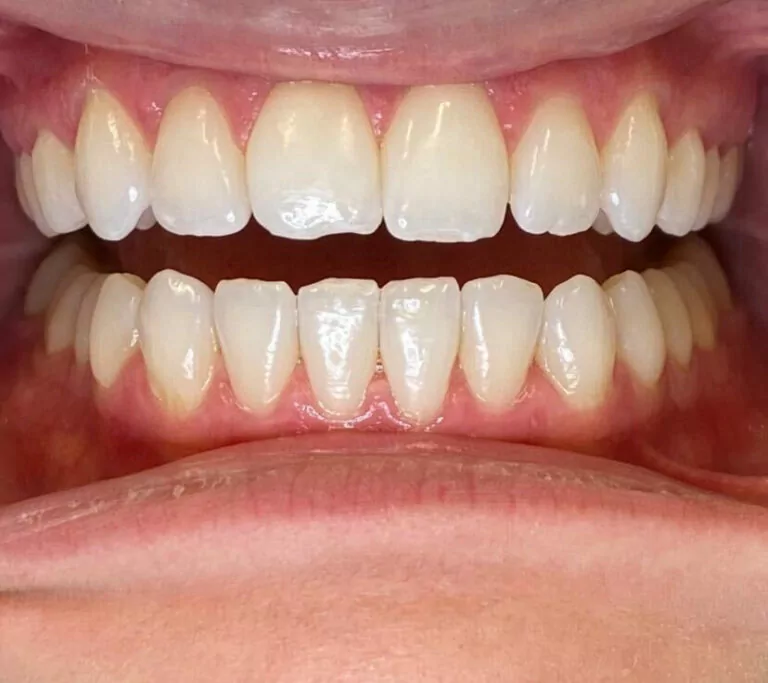 Close-up of a person's teeth showing both the upper and lower rows.