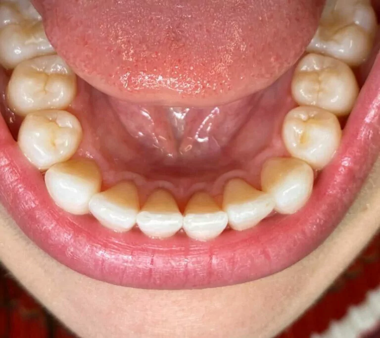 The image shows the lower jaw of a person's mouth, focusing on the teeth and gums. The teeth appear straighter and more aligned, likely reflecting the results after Invisalign treatment.