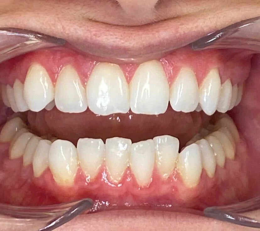 A close-up image of a person's open mouth showing their teeth and gums with dental retractors holding the lips apart.