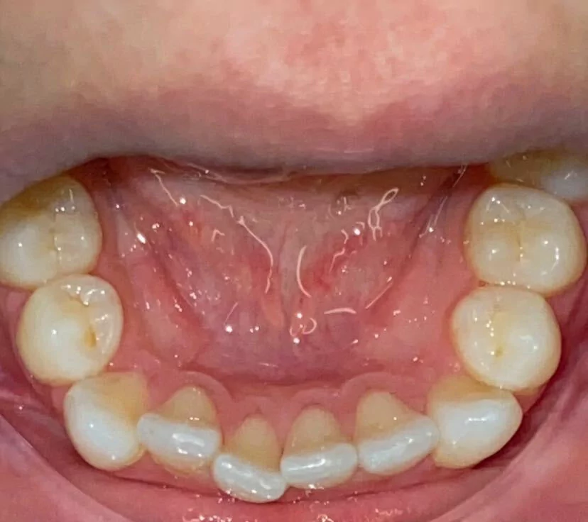 The image shows the lower jaw of a person's mouth, focusing on the teeth and gums. The teeth appear slightly misaligned, likely indicating their condition before undergoing Invisalign treatment.
