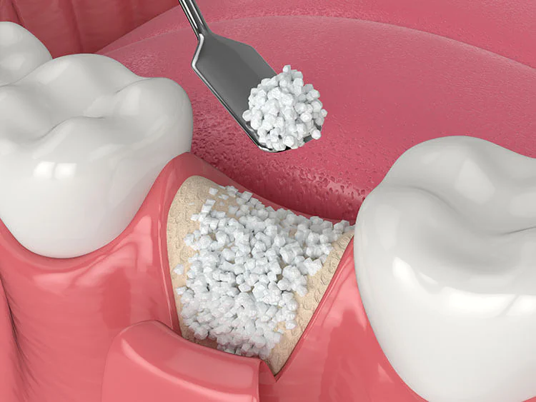Dental bone grafting available at LoPresti Dental Group in Stamford, CT