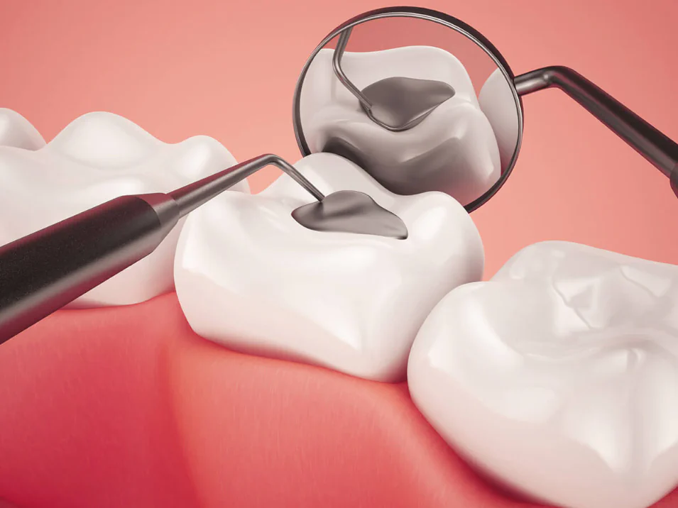 Dental fillings and sealants available at LoPresti Dental Group in Stamford, CT
