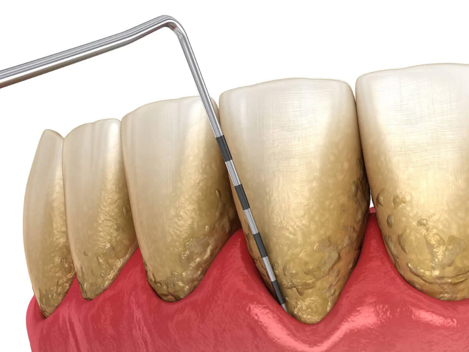 Gum disease treatment and periodontal treatment at LoPresti Dental Group in Stamford, CT