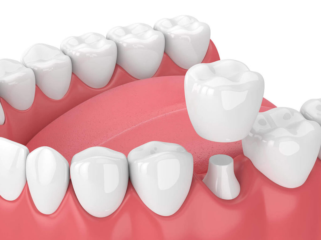 illustration of dental crown being placed