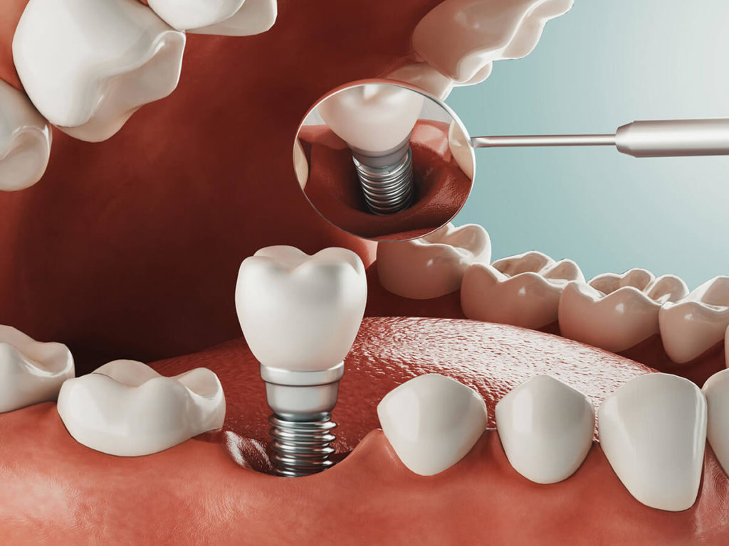 illustration of dental implant being placed in mouth