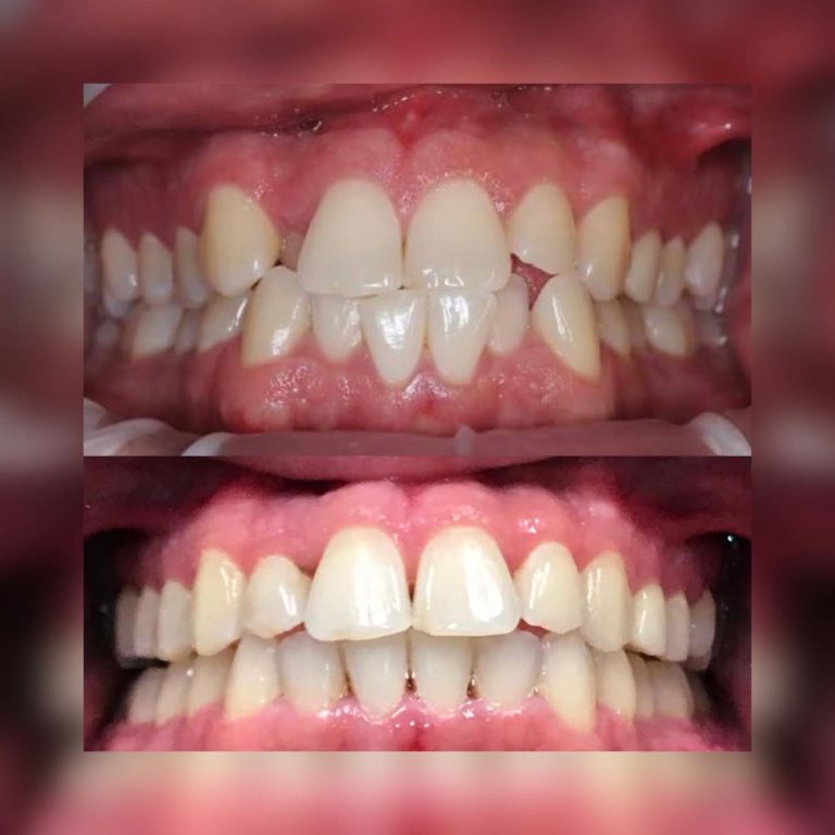 lopresti cosmetic and family dentistry smile gallery 1