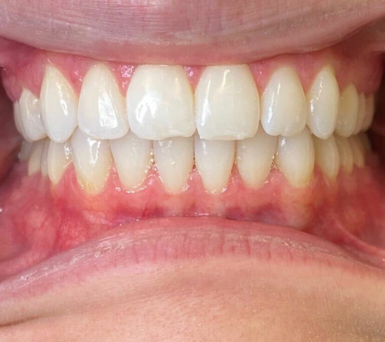invisalign after smile gallery 2