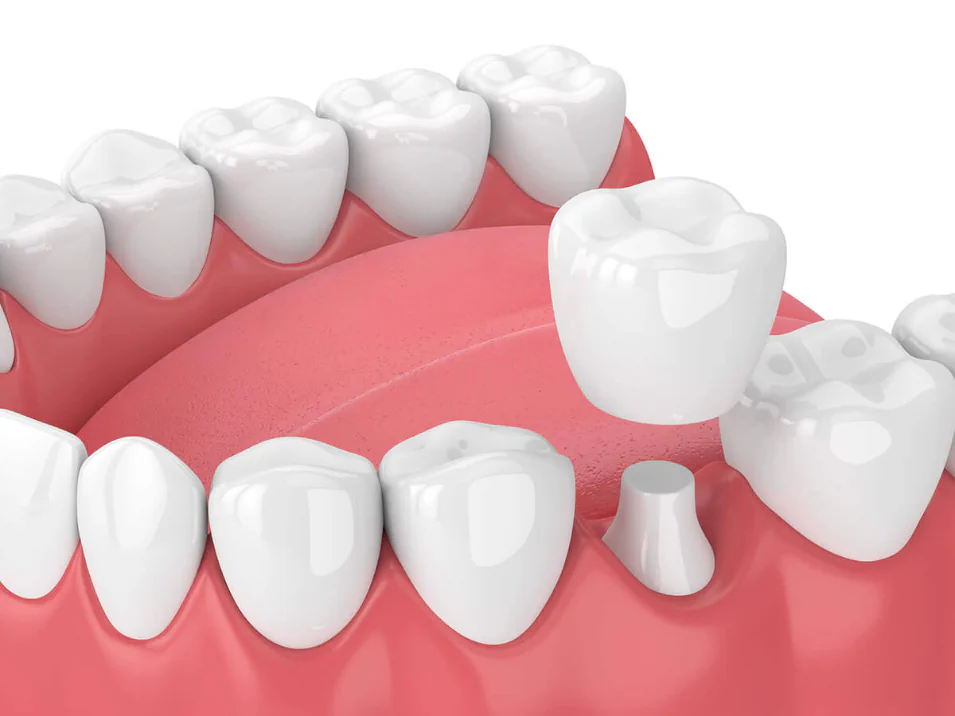 Dental crowns and dental bridges available at LoPresti Dental Group in Stamford, CT