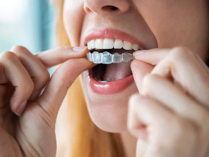 Clear aligners and Invisalign available at LoPresti Dental Group in Stamford, CT