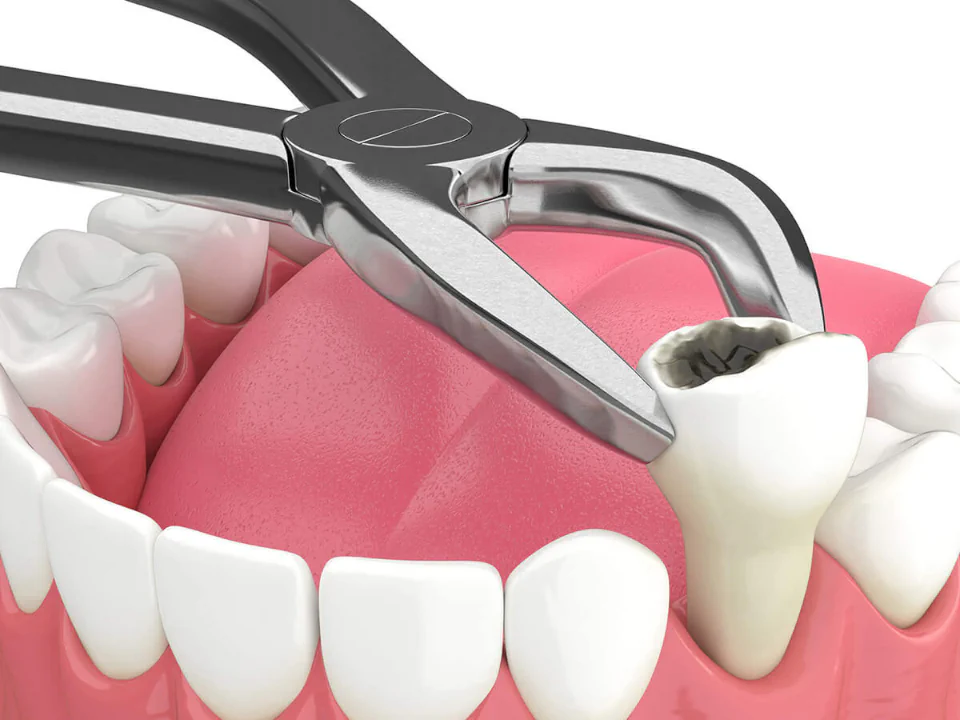 Tooth extractions available at LoPresti Dental Group in Stamford, CT