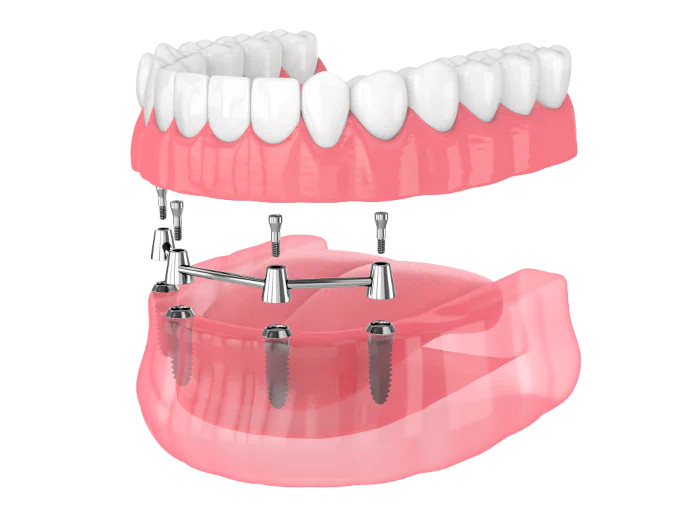 All-on-4 dental implants available at LoPresti Dental Group in Stamford, CT
