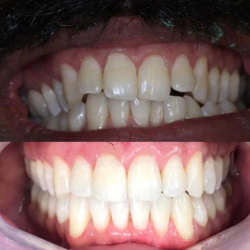 Before and after Invisalign treatment at LoPresti Dental Group in Stamford, CT