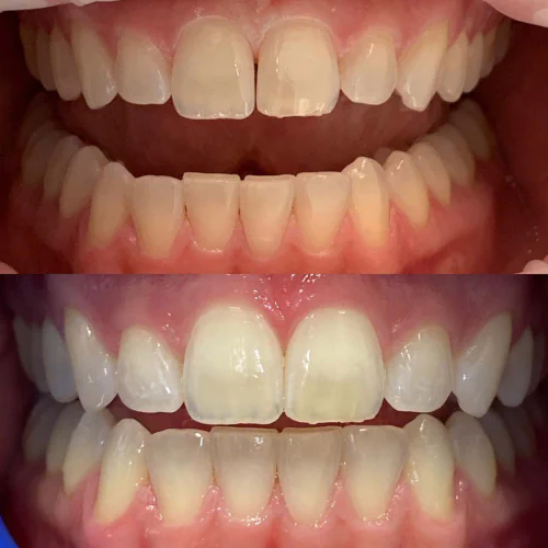 Before and after Invisalign treatment at LoPresti Dental Group in Stamford, CT
