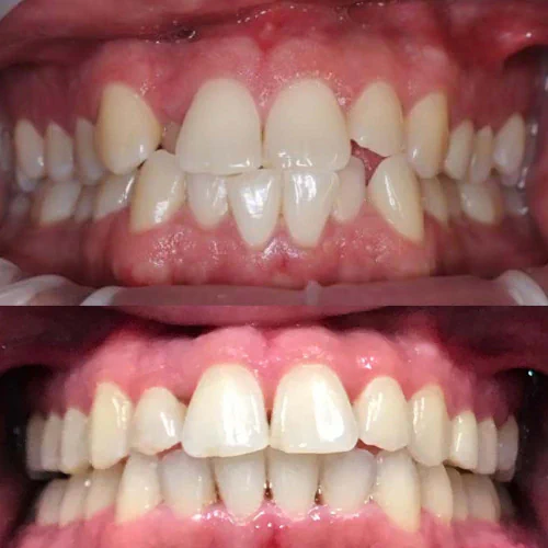 Before and after Invisalign treatment at LoPresti Dental Group in Stamford, CT