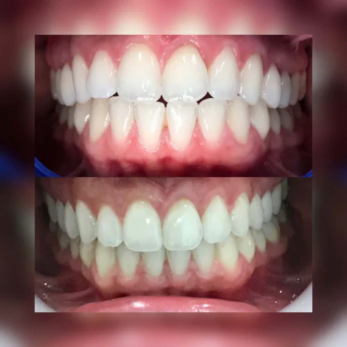 Before and after Invisalign treatment at LoPresti Dental Group in Stamford, CT