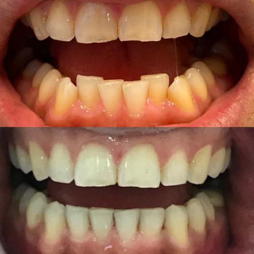 Before and after Invisalign treatment at LoPresti Dental Group in Stamford, CT