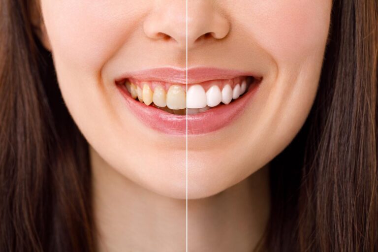 Split image showing a woman’s smile before and after teeth whitening, with the left side displaying yellowed teeth and the right side showing noticeably whiter, brighter teeth.